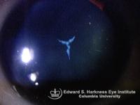 Anterior sutural cataract in a slit-lamp and retroillumination view.